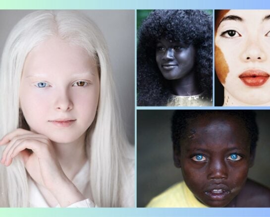 These Fascinating Photos Show the Beauty of Genetic Rarity