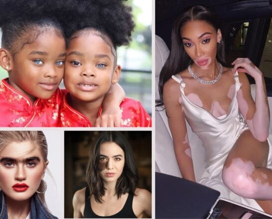 Discover These Extraordinary People Whose Unique Traits Have Made Them Famous